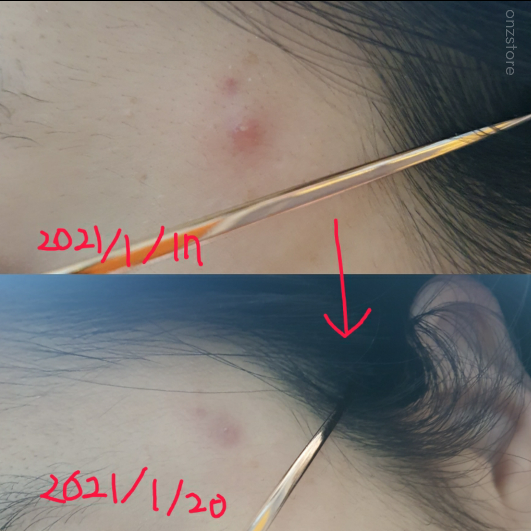 ★Hatherine★ Spot Care Patch