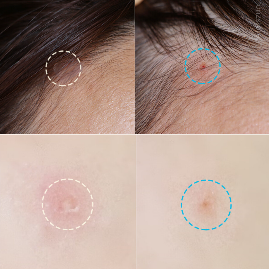 ★Hatherine★ Spot Care Patch