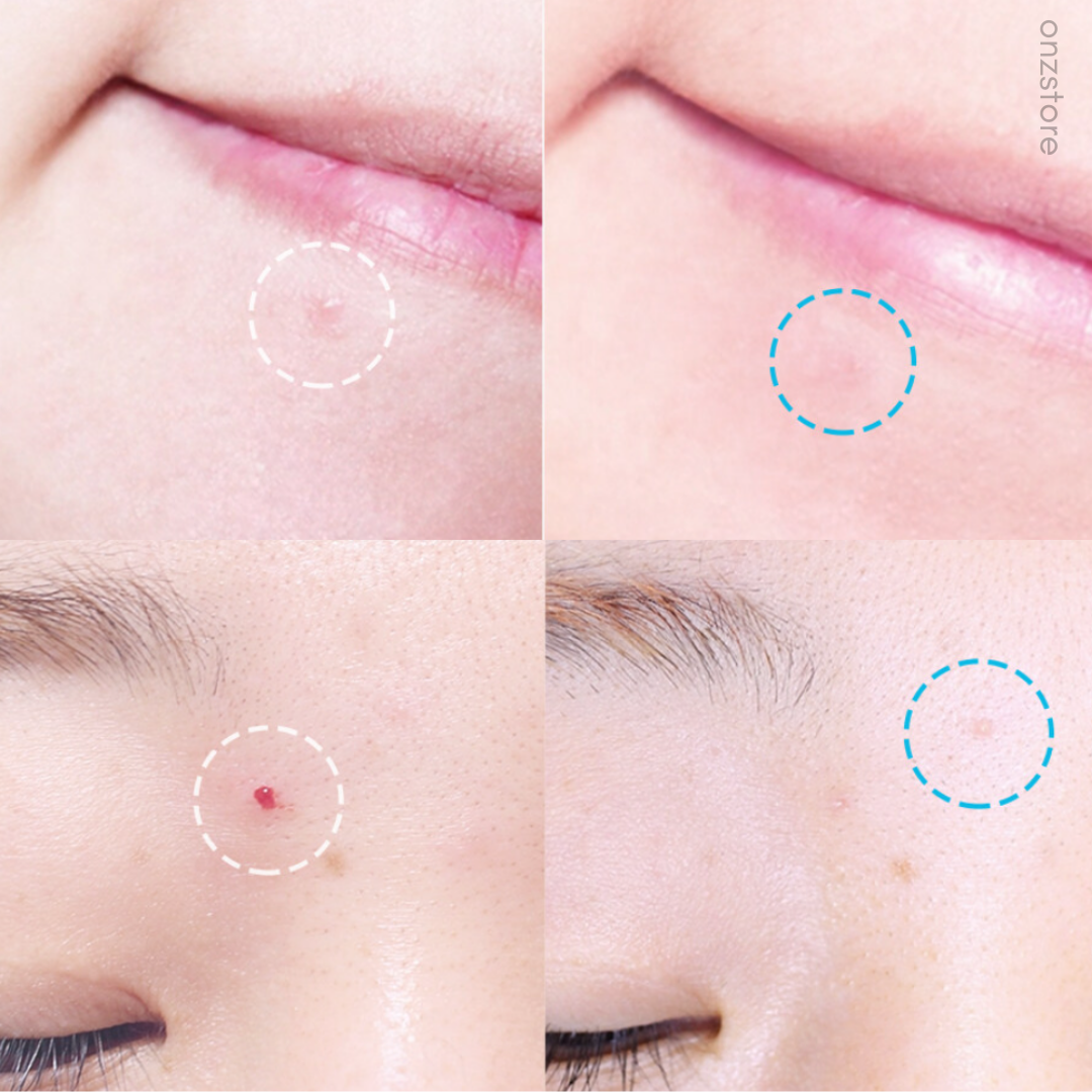 ★Hatherine★ Spot Care Patch